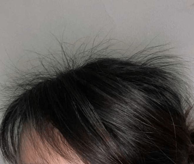 湿气太重会脱发？头顶秃秃很好解决这两个技巧发量多到溢出来！(图4)