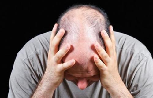 易倍体育网站：假发掉发了可以进行补救吗？（详细诠释）(图1)