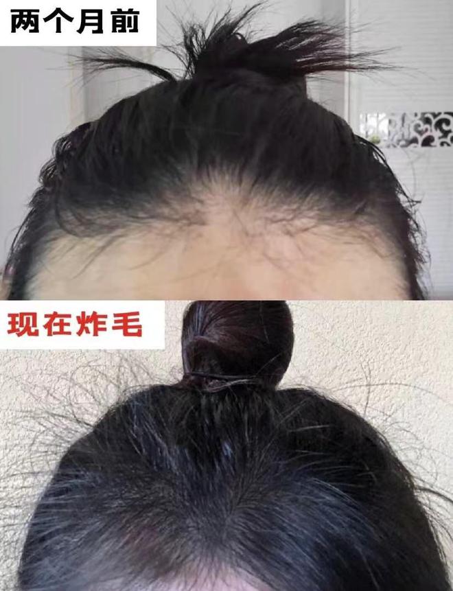 跪谢！原来掉头发真可以长出来！细软塌亲测有效的防脱生发指南！(图4)