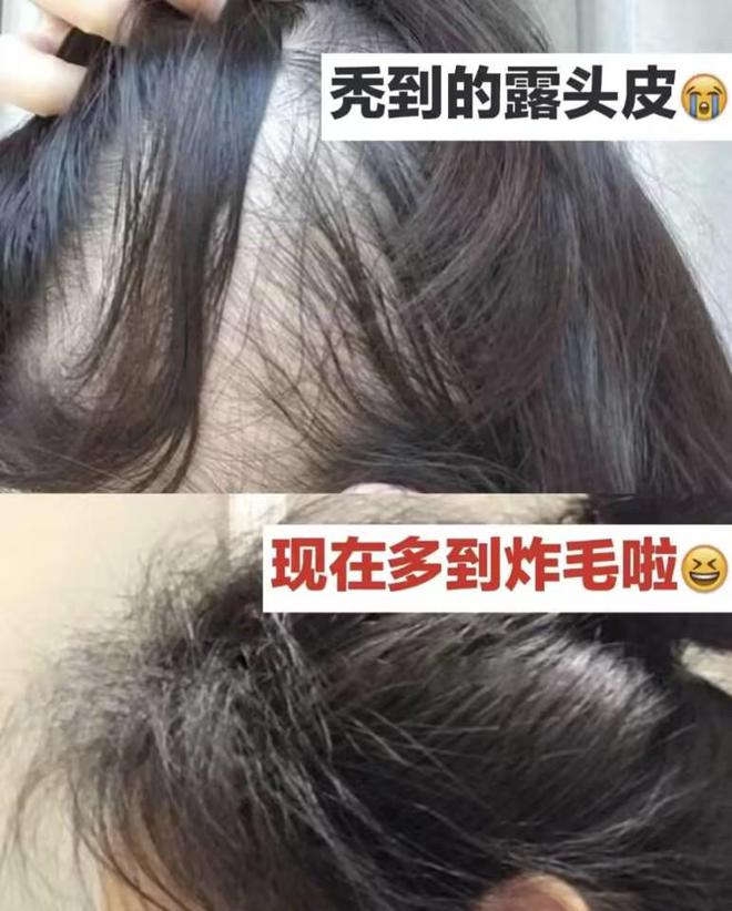 头发稀疏速进！这款洗发水秃头党只求不停产！21天逆袭发量王者！(图4)