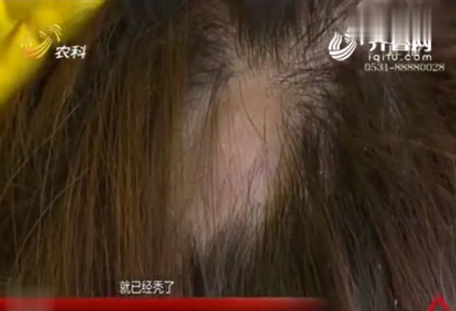 女大学生1600元接发头发却秃了3大块怒曝光：我出去怎么见人(图3)