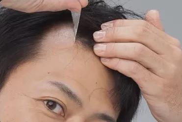 Emc易倍体育：告别脱发尴尬！了解男士补发如何重塑自信形象(图2)