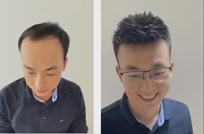Emc易倍体育：告别脱发尴尬！了解男士补发如何重塑自信形象(图3)