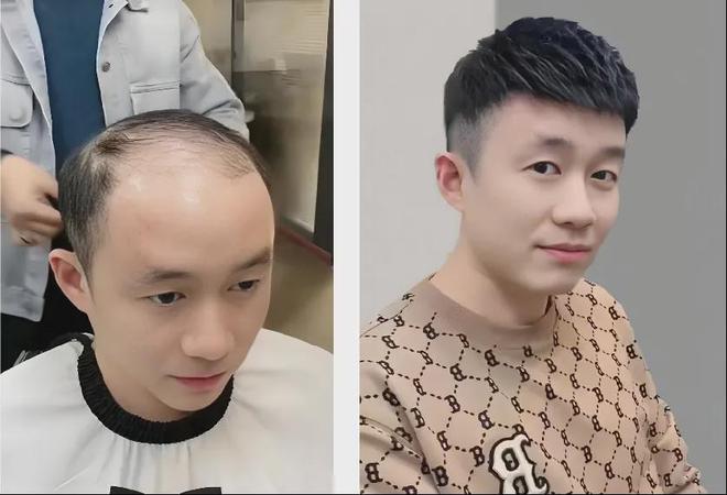 Emc易倍体育：告别脱发尴尬！了解男士补发如何重塑自信形象(图5)