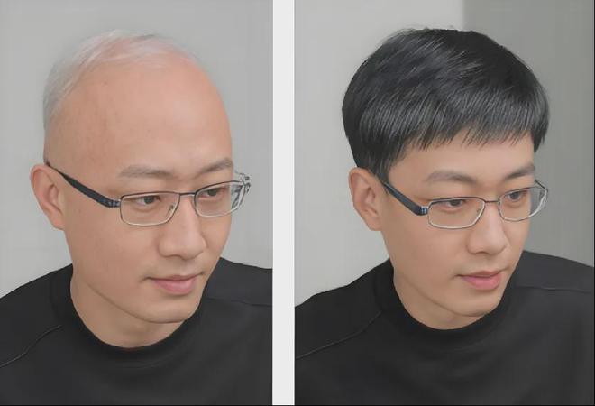 Emc易倍体育：告别脱发尴尬！了解男士补发如何重塑自信形象(图7)