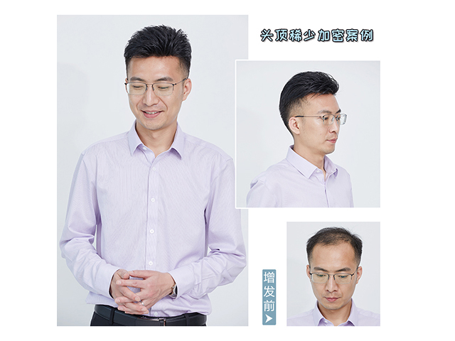 真人发丝男士假发品牌改变脱发形象真的就如此简单(图2)