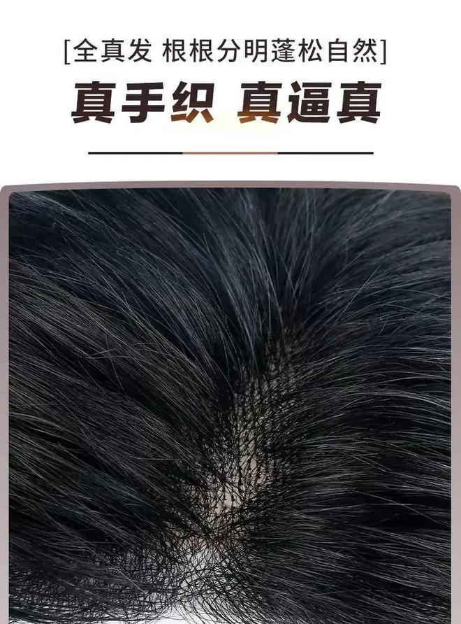 拯救发际线脱发严重假发VS植发怎么选？(图2)
