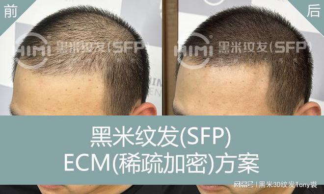 黑米纹发(SFP)：植发以后纹发——探索头发恢复浓密的新途径(图3)
