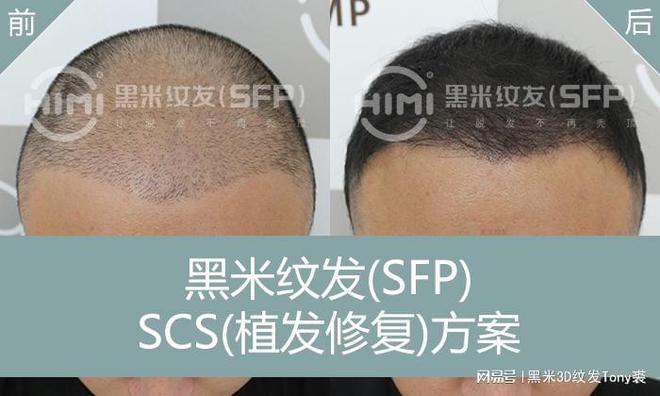 黑米纹发(SFP)：植发以后纹发——探索头发恢复浓密的新途径(图4)