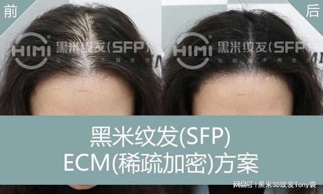 易倍体育网站：纹发能否拯救头发稀少？深度剖析与实例见证(图3)